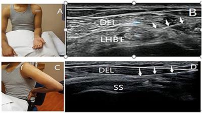 The Effectiveness of Ultrasound-Guided Subacromial-Subdeltoid Bursa Combined With Long Head of the Biceps Tendon Sheath Corticosteroid Injection for Hemiplegic Shoulder Pain: A Randomized Controlled Trial